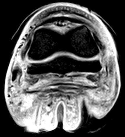 Figuur 22: MRI beeld van de linker voet, transversale snede, STIR. Figuur 23: MRI beeld van de linker voet, frontale snede, T1.