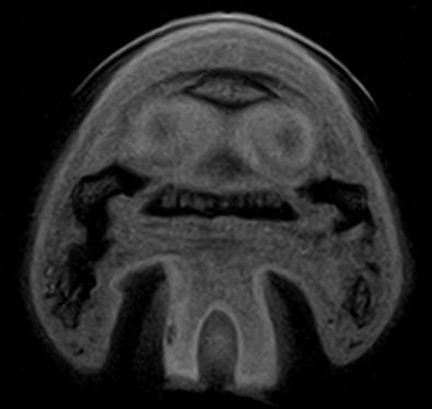 Figuur 29: MRI beeld van de rechter voet,