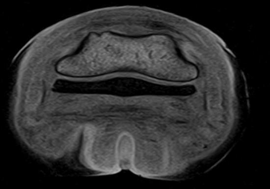 Figuur 30: MRI beeld van de rechter voet,