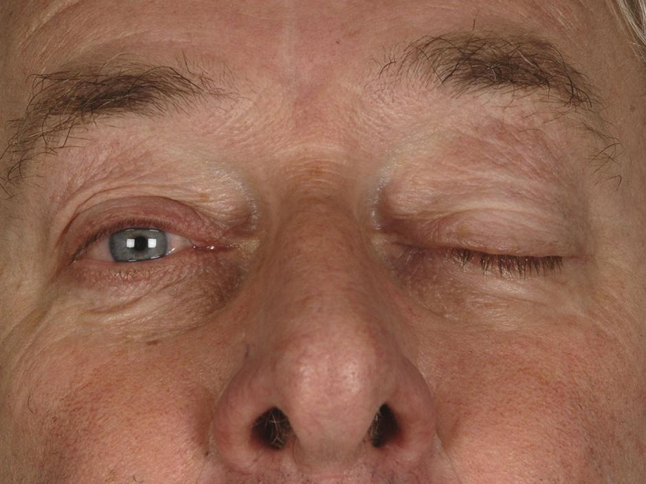 FIGUUR 3 Foto van patiënt B waarop een afhangend linker ooglid (ptosis) te zien is, wat past bij een parese van de N. oculomotorius links (afgedrukt met toestemming van belanghebbende). ontstaan.