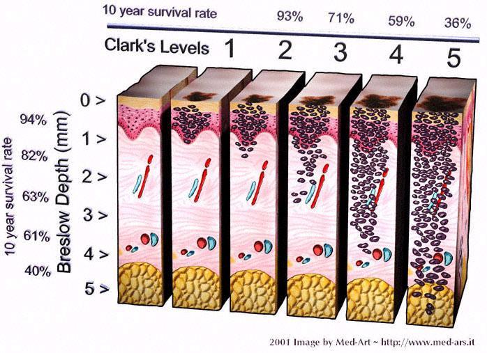 5.1 Andere Stageringssystemen Melanoom De twee voornaamste andere stageringssystemen zijn die van Breslow (invasiediepte in mm) en Clark (invasiediepte volgens anatomie) 6 Melanoom diagnostiek Elk