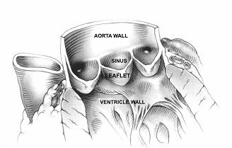 Inleiding Figuur 2: De anatomie van de aortaklep. De drie klepbladen en de sinussen zijn zichtbaar. Twee van de drie sinussen bevatten een ostium van de coronaire arteriën. Bron: Mol A.