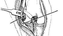 De fascia lata strip wordt vervolgens doorheen de gaten gehaald, strak aangetrokken en vastgehecht langs de rechte patellaband 19. 3.2.