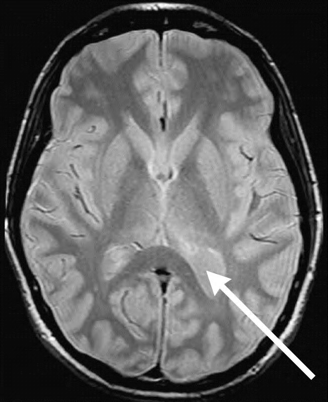 In figuur 4 staat het verloop op een bepaald moment van het totale magnetisch veld B MRI schematisch weergegeven. De patiënt blijft op dezelfde plaats liggen. Figuur 4 staat ook op de uitwerkbijlage.