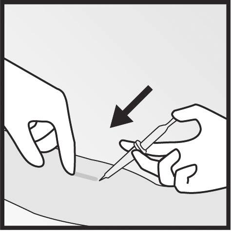 steriele marker Verdoof de arm bijvoorbeeld met 0,5 tot 1 ml lidocaïne (1%) op de gemarkeerde plaats waar de incisie zal