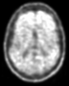 [ 18 F]florbetaben PET scan Frames van 4 x 5 minute, 90-110 na injectie ~ 300 MBq [ 18 F]florbetaben Visuele beoordeling door getrainde nucleaire geneeskundige Positief wanneer corticale opname in 1