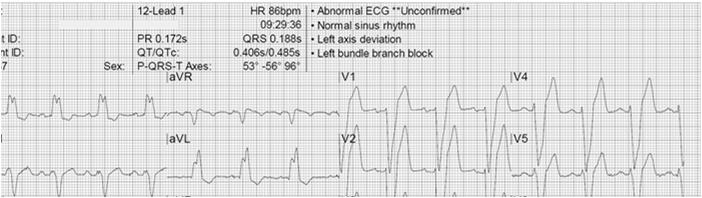 QTc? Verschillende QT-correcties gebruikt: Meeste alleen rate-correction: Bazett, Fridericia, Framingham, Hodges Slechts 1 corrigeert ook voor verlengd QRS: Rautaharju Bazett: QTcB = QT / RR1/2