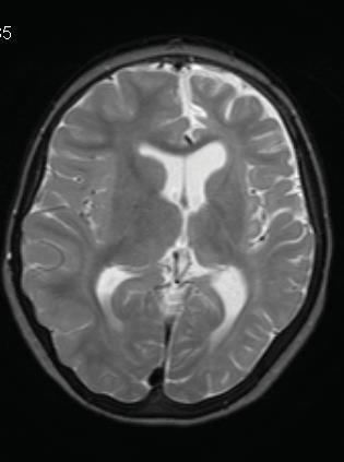 Cognitieve stoornissen Chronische epilepsie