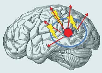 Wat is epilepsie? Wat is een epileptische aanval?