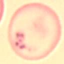 Ter herinnering een kleine samenvatting van sikkelcelziekte: Het is een constitutionele corpusculair hemolytische anemie te wijten aan een puntmutatie in het gen van -globine.