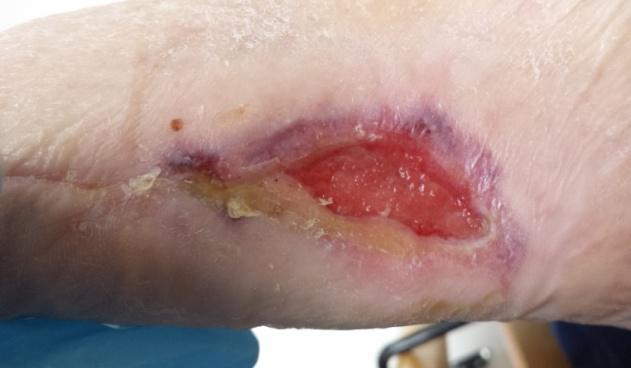 Start dagelijks reinigen met Microdacyn Wound Care en afdekken met Foam Border voor ideale