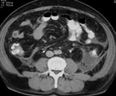 Terwijl de tafel verschuift, wordt een serie foto s gemaakt. Deze foto s geven een duidelijk beeld van de plaats, grootte en uitgebreidheid van een mogelijke tumor en/of uitzaaiingen.