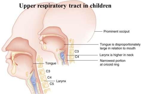 Kind versus volwassene Volwassene: Gecalcificeerd laryngeaal complex: fractureert op meerdere plaatsen Kind: Kraakbenig