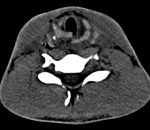 Casus 2 stomp larynx trauma Jongen, 17 jaar oud.