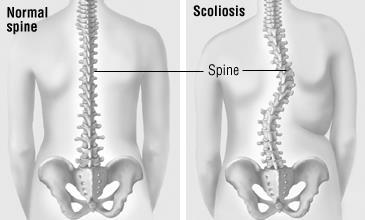 Wat is een scoliose? Een scoliose is een driedimensionale zijdelingse verkromming van de wervelkolom. De wervelkolom bestaat uit 33 (en soms 34) botstukken die lopen van de nek tot het staartbeen.