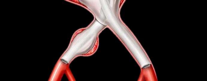 Afbeelding 7: Voorbeeld van verkregen distale afsluiting (waar de EndoBag de aortawand raakt) 10 mm Lage/verkeerd uitgelijnde plaatsing van stent De verkregen afsluitingsgebieden omvatten