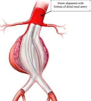 onderzijde van het eerste stentcelelement ligt op één lijn met het distale beginpunt van de meest caudale arteria renalis) en spiralen/vloeibare embolische middelen met commercieel verkrijgbare