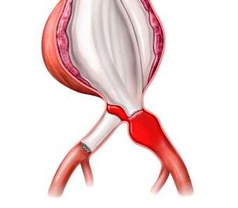 van de Ovation ix Iliac-stentprothese als een distale extender om het afsluitingsgebied te herstellen.