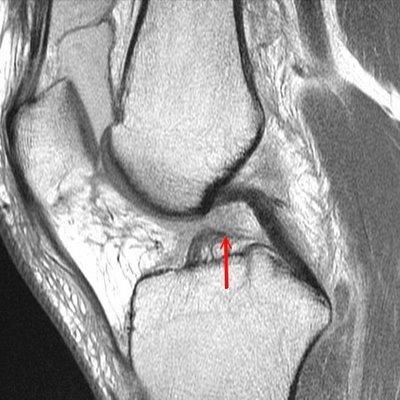 Links röntgenopname van de knie met een VKB ruptuur. Rechts MRI van een VKB ruptuur.