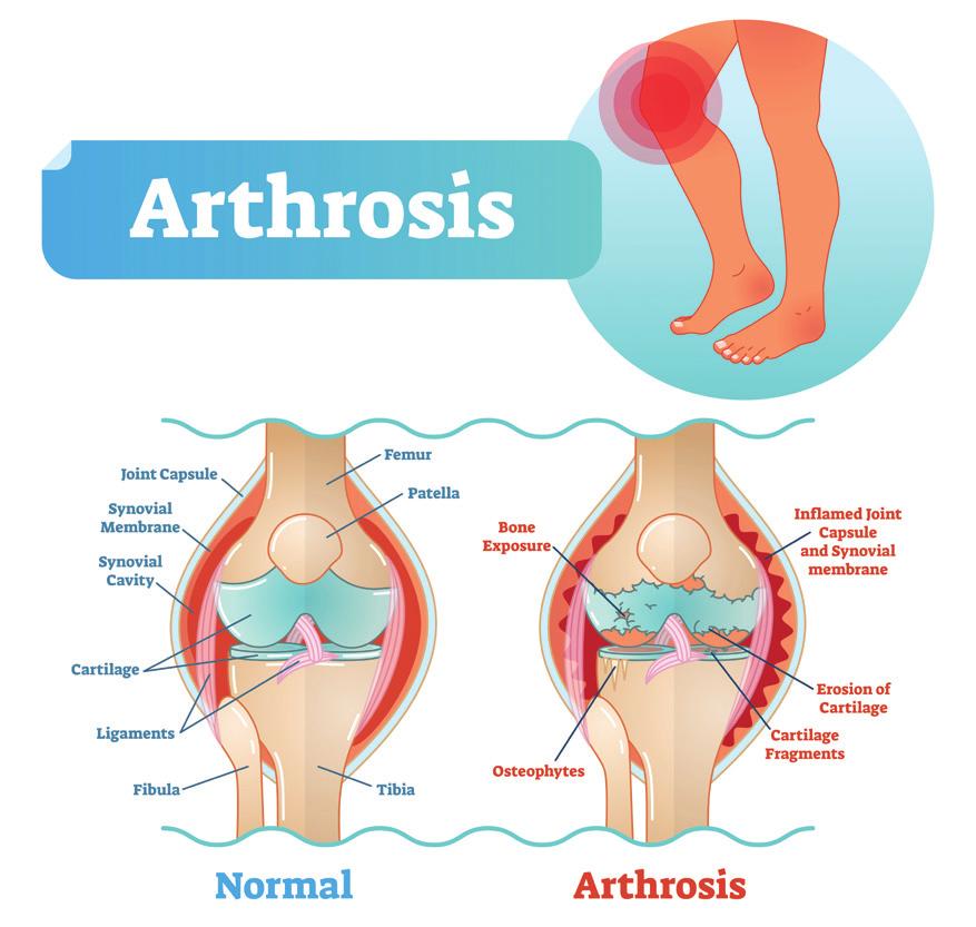 Algemeen Er is bij u artrose in uw knie vastgesteld. Aan de hand van deze folder krijgt u informatie over de knie, de diagnose artrose, de gevolgen en behandeling van artrose.