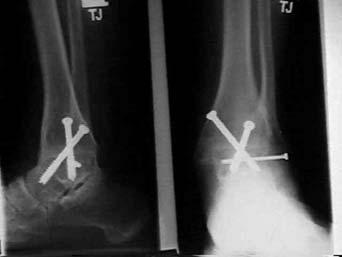 behandeling arthrosis na een fractuur afgeronde hiel proximale afwikkelingscorrectie zoolverstijving buffer hiel contrefortverstijving arthrodesekoker arthrosis na een fractuur Als het