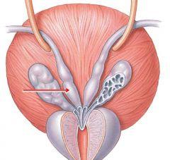 Sterilisatie bij de man gebeurt meestal door de zaadleiders door te knippen en af te binden of door er een gel in te spuiten.