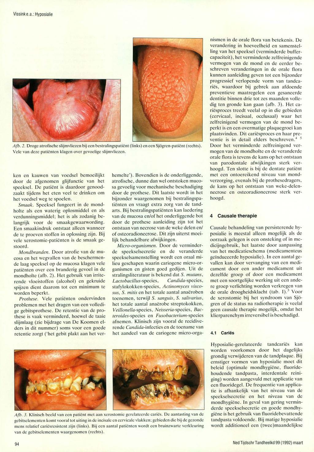Vissink e.a.: Hyposialie Afb. 2. Droge atrofische slijmvliezen bij een bestralingspatiënt (links) en een Sjögren-patiënt (rechts). Vele van deze patiënten klagen over gevoelige slijmvliezen.