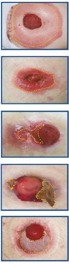 Pyoderma gangrenosum Definitie: een ulceratieve huidafwijking rondom de stoma door onbekende oorzaak Vaak onderliggend lijden: reuma,