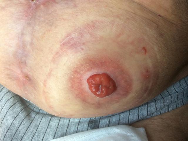 zit LINKS) 11-2015 Hartmann (colostoma zit RECHTS) Colostoma: 2-delig coloplast sensura flex 50 mm Urostoma:1-delig