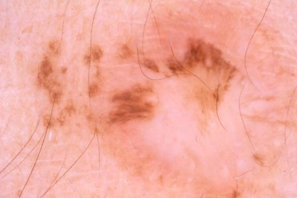 in huidletsels met toegenomen hoeveelheid dermal collageen (fibrose).