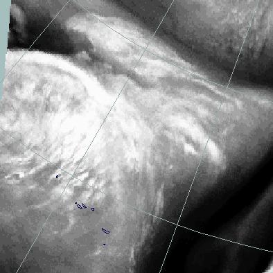 Het betreft hier een grootschalig wolkendek Fig 6: WV-beeld 7 april 1996 18:00 UTC: gevorderd stadium in de snelle cyclogenese behorende bij een uitslaande golf.