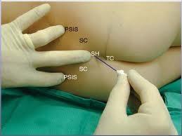 ligament) => naald in een hoek van 20-30 : parallel. => max 0,5cm opschuiven!! Controle van naaldpos : Negatieve aspiratie geen uitsluiting van intrathecale of intravasc.