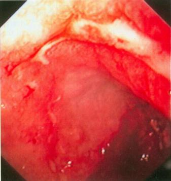 Het kan moeilijk zijn de ulcera te onderscheiden van benigne en carcinomateuze ulcera (Figuur 3A).