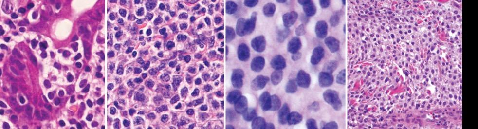 A B C D Figuur 4: Cytologisch spectrum van neoplastische B-cellen in MALT lymfoma's.