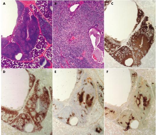 u Figuur 5: Typische immunoarchitectuur van MALT lymfoma's met betrekking tot de glandula parotis (DALT).