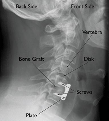 Techniek Anterieure cervicale decompressie met fusie (ACDF) Cervical