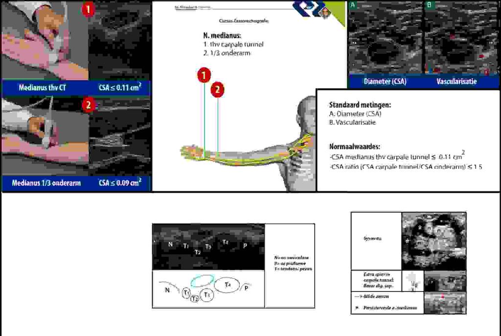 Figuur 3. Overzicht van protocollaire meetpunten en normaalwaarden voor onderzoek naar CTS. Een oppervlakte van de n.