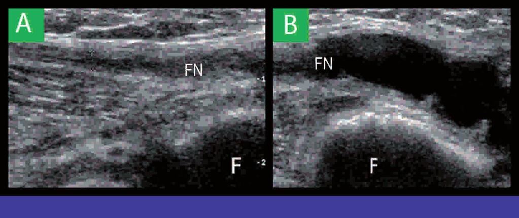 Fibularis neuropathie Een compressieneuropathie van de n. fibularis komt op alle leeftijden voor, vaker bij mannen dan bij vrouwen [34].