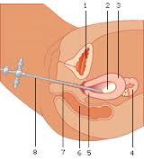 bij u net iets anders verloopt dan hier beschreven. Uw arts zal dit altijd met u bespreken. Fig1 1. blaas, 2. baarmoederholte, 3. baarmoederwand, 4. eierstok, 5. baarmoedermond, 6. darm, 7. vagina, 8.