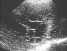 Echografie thorax Differentiatie massa/vocht Exacte locatie van pleuraal vocht pleurapunctie (geen blinde puncties!