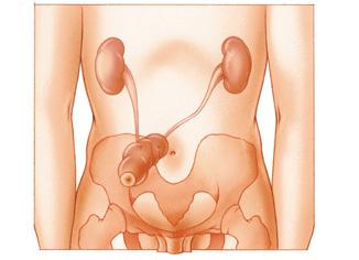 Urinestoma of neoblaas Is uw blaas verwijderd, dan kan de urine het lichaam niet meer langs de natuurlijke weg verlaten.