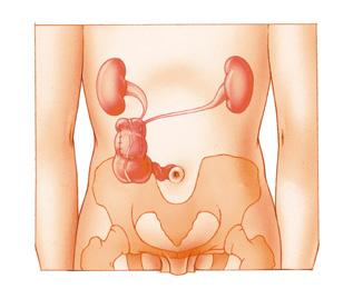 Continent urinereservoir - Een continent urinereservoir wordt gemaakt van een stuk dunne en een stuk dikke darm. De uroloog sluit hierop aan de bovenkant de 2 urineleiders aan.