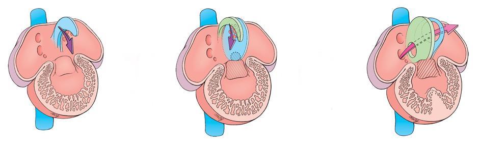 Van gekromde buis naar 4 kamerhart Atrium Septum defect type 1 en