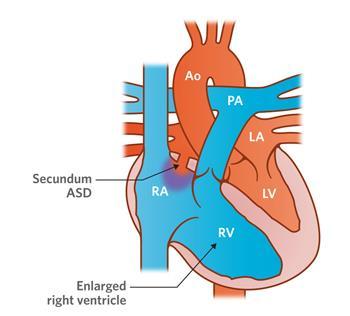 Gevolgen aangeboren hartafwijkingen Atrium Septum Defect (type