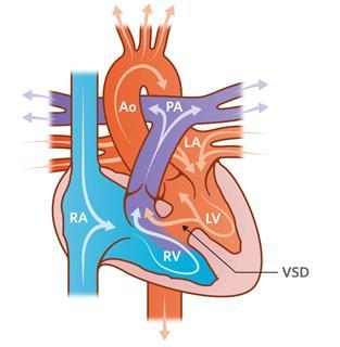 Gevolgen aangeboren hartafwijkingen (groot) Ventriculair Septum Defect 60 NIBI congres