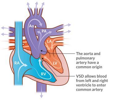Gevolgen aangeboren hartafwijkingen persisterende truncus arteriosus 62 NIBI congres