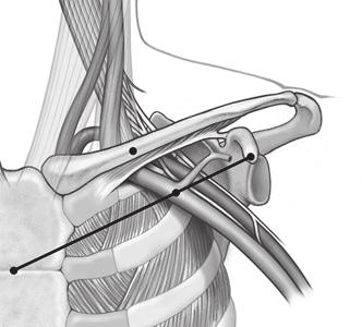 waar deze over de eerste rib loopt (niet verder mediaal) om te voorkomen dat de lead beklemd raakt in de musculus subclavius of in ligamentstructuren in het nauwe costoclaviculaire gebied.