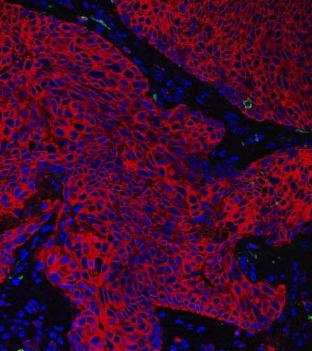 Tumor Infiltrating Lymphocyten (TIL)