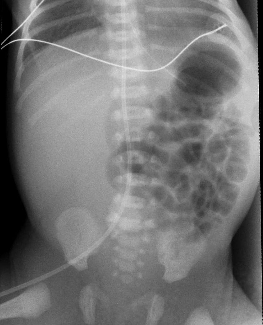 Neonataal abdomen Neonaat dag 0 Wat