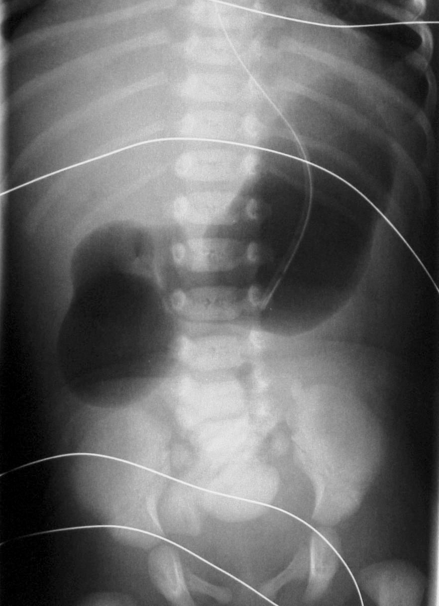 Neonataal abdomen Totale duodenum obstructie